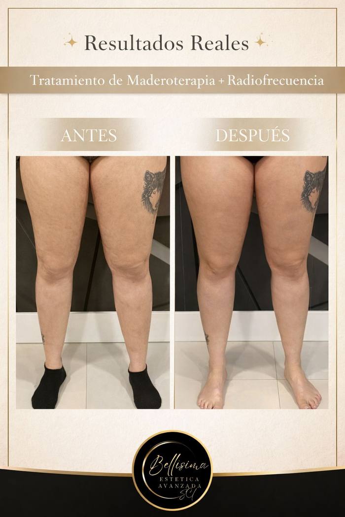 Antes y después maderoterapia piernas